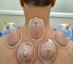 Cupping Therapy